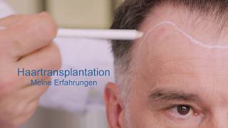 Meine Haartransplantation Erfahrungen  Erfahrungsbericht zur Haarverpflanzung bei Geheimratsecken [upl. by Xilef459]