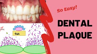 Dental Plaque  Types and Formation [upl. by Cari]