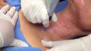 Dermapen video explaining procedure and showing procedure done [upl. by Jemina]