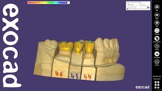 exocad Quick Guide New features in DentalCAD 22 Valletta [upl. by Nikita]