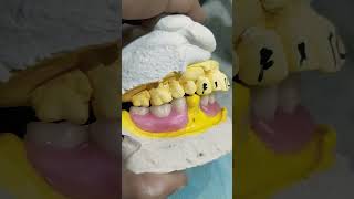 Lower Removable Partial Denture partialdenture rpddentalprocedure [upl. by Amis238]