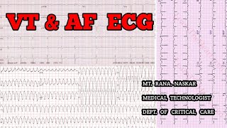 VENTRICULAR TACHYCARDIA amp ATRIAL FIBRILLATION ECG CRITERIAPATIENT FEATURESMT CCU [upl. by Aynom]