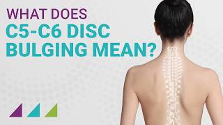 What Does C5C6 Disc Bulging Mean [upl. by Brass]