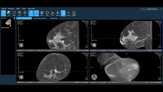 Koning Health Clinical Review Ductal Carcinoma in Situ Calcifications [upl. by Crean]