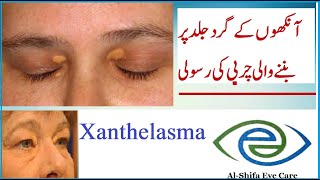 What is Xanthelasma Prevacation and Treatment [upl. by Vachil]