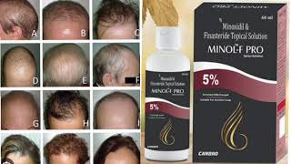 MINOL F PRO Topical Solution 5 Minoxidil amp Finasteride Topical Solution [upl. by Alyse281]