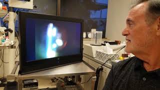 Eye Floater Treatment with Laser patient of Scott Geller MD [upl. by Stetson]