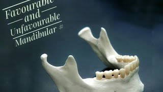 Mandibular Fractures  Favourable and Unfavourable [upl. by Sherie]