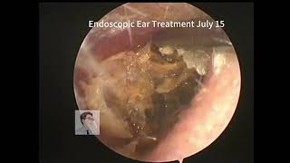 Completely blocked ear cleaning 20230715 [upl. by Jase]