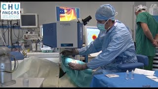 La chirurgie au laser en ophtalmologie du CHU Angers [upl. by Konyn]