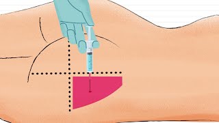 Como Aplicar Inyección Intramuscular en el GLUTEO 🍑 [upl. by Vedis134]