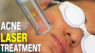 Acne Laser Treatment  CO2 Laser Treatment For Acne Scars  Dr Priya Prabakar Medical Cosmetologist [upl. by Einaffit]