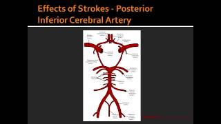 Effects of Strokes  Posterior Inferior Cerebral Artery [upl. by Hedwig566]