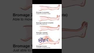 Bromage Score  Anesthesia painmanagement shoreyoutube viral video medical [upl. by Nattirb611]