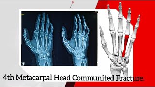 4TH METACARPAL HEAD COMMUNITED FRACTURE CRIF WITH MULTIPLE 12 K WIRES USING BOUQUET TECHNIQUE [upl. by Sayles704]