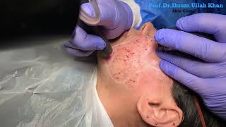 Unbelievable Skin Transformation with Erbium YAG Laser Acne Scar Treatment lasertreatment acne [upl. by Nojid]