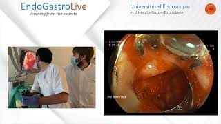 Hemostase endoscopique dun ulcère duodénal hémorragique [upl. by Sorensen]