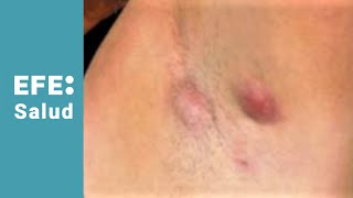 Hidradenitis supurativa abscesos en la piel y mal olor [upl. by Alaaj]