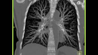 Lung Anatomy Normal Lung Vasculature [upl. by Irrahs951]