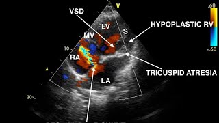 Tricuspid Atresia Echocardiography [upl. by Arahsak]