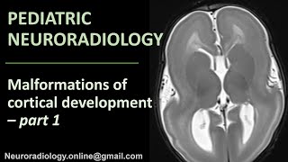 Pediatric Neuroradiology  Malformations of Cortical Development part 1 [upl. by Anirroc634]