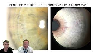 Treatment of narrow angles Laser Peripheral Iridotomy with hemorrhage [upl. by Halsy]