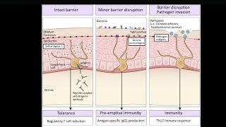 Mystery diagnosis Langerhans cell histiocytosis [upl. by Eaner]