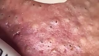 Blackheads amp Whiteheads Satisfying Removal 0275 [upl. by Eseret495]