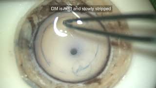 Descemet Membrane Endothelial KeratoplastyDMEK Preparation of Donor cornea [upl. by Yelha281]