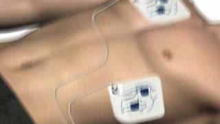 How to use an AED automated external defibrillator [upl. by Olia]