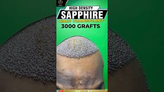 HairTransplant sapphire HairTransformation HairJourney HairGrowth BeforeAndAfter NewHair [upl. by Laicram]