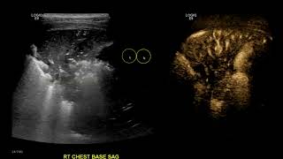 Pleural Effusion versus Pericardial Effusion on Ultrasound Imaging [upl. by Kleiman60]