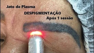 RESULTADO DE DESPIGMENTAÇÃO DE SOBRANCELHAS COM JATO DE PLASMA ELETROCAUTÉRIO [upl. by Leeanne337]