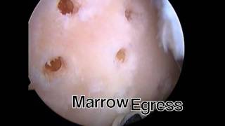 Arthroscopic MicroFracture Trochlear Groove by Chad Smalley MD [upl. by Jolanta199]