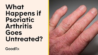 What Happens if Psoriatic Arthritis Goes Untreated  GoodRx [upl. by Alenas]