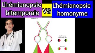 lhémianopsie homonyme et bitemporale [upl. by Quartas]