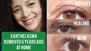 Xanthelasma Removal at Home 6 Years Ago  Fatty Eye Cholesterol Deposit  Before amp After Photos [upl. by Averir567]