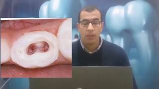 البيدو pulpotomy ولا pulpectomy [upl. by Ydnac]