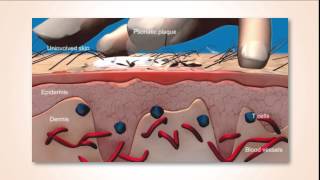 Dermatologie Psoriasis voorlichting [upl. by Audwin133]