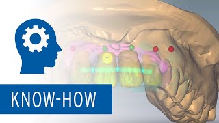 Ceramill MGin software module  Workflow tutorial creation of implantsupported bridges [upl. by Ak]