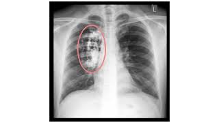 Neumonía cáncer pulmonar fibrosis quística Tuberculosis [upl. by Lonna641]