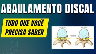 Abaulamento Discal  O que você precisa saber [upl. by Gombach]