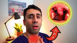 What Causes a Sore Throat HOME Remedies and Cures for Fast TREATMENT Doctor Explains [upl. by Earl96]