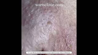 HPV warts Imiquimod and burning and podophyllin failed treatment  10 years of infection [upl. by Aciretal]