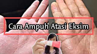 AKHIRNYA NEMU SKINCARE YANG AMPUH ATASI EKSIMKU‼️  EKSIM DISHIDROSIS  POMPHOLYX [upl. by Rellim207]