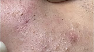 Acne treatment for Spa Linh Mun 2023 003 [upl. by Gnoh]