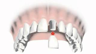 implantes dentales precios 2012  Consejos al Momento de Escoger implantes dentales precios 2012 [upl. by Vick]