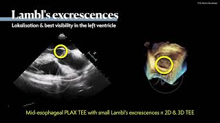 〖Echocardiography〗 Lambls excrescences amp fibroelastoma in TEE 🫀 [upl. by Aramoj]