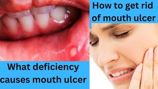 What is the fastest way to cure mouth ulcer  What deficiency causes the mouth ulcer [upl. by Eiznik]