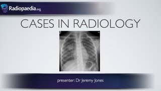 Cases in Radiology Episode 3 pediatric chest xray [upl. by Woll]